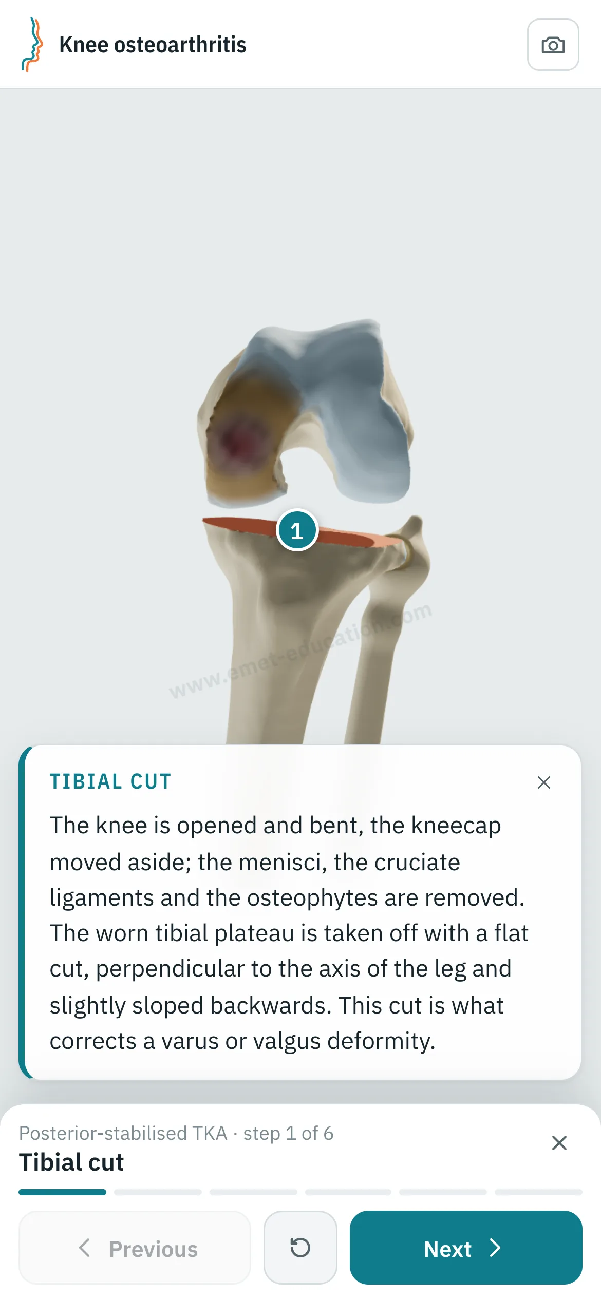 Patient view on a phone: the total knee arthroplasty replayed step by step.