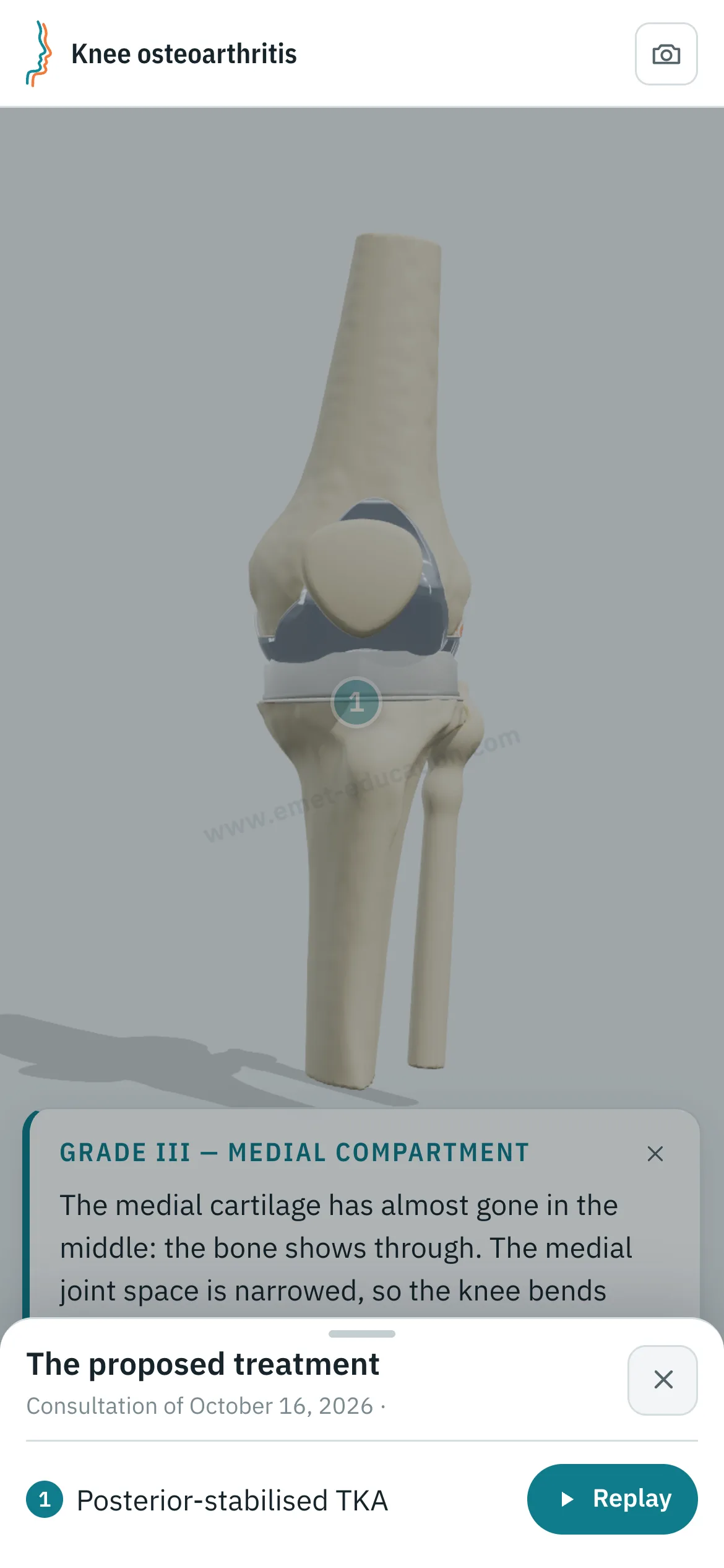 Patient view on a phone: the knee after total arthroplasty, and the “The proposed treatment” panel open, with the “Replay” button.