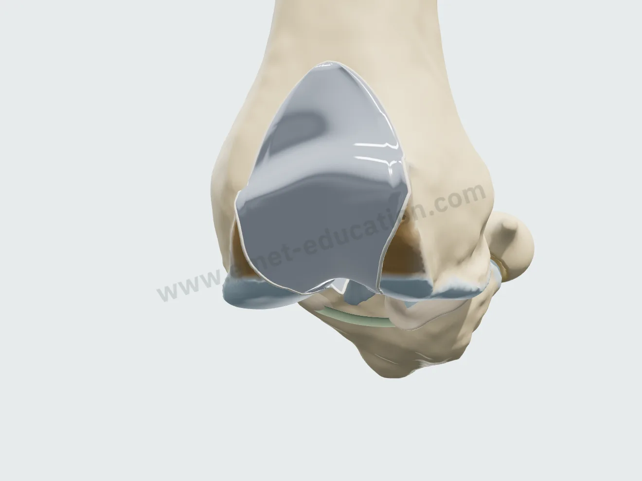 Patellofemoral arthroplasty, step 2: shield-shaped trochlear component, tongue centered on the groove.