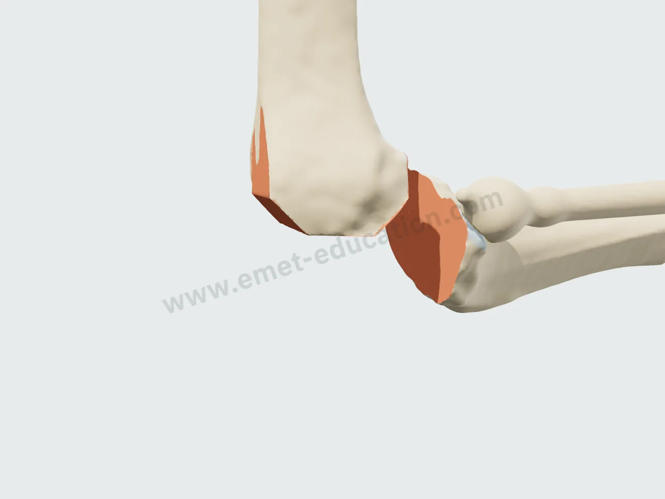 Total arthroplasty, step 2: distal, posterior, anterior and chamfer femoral cuts.