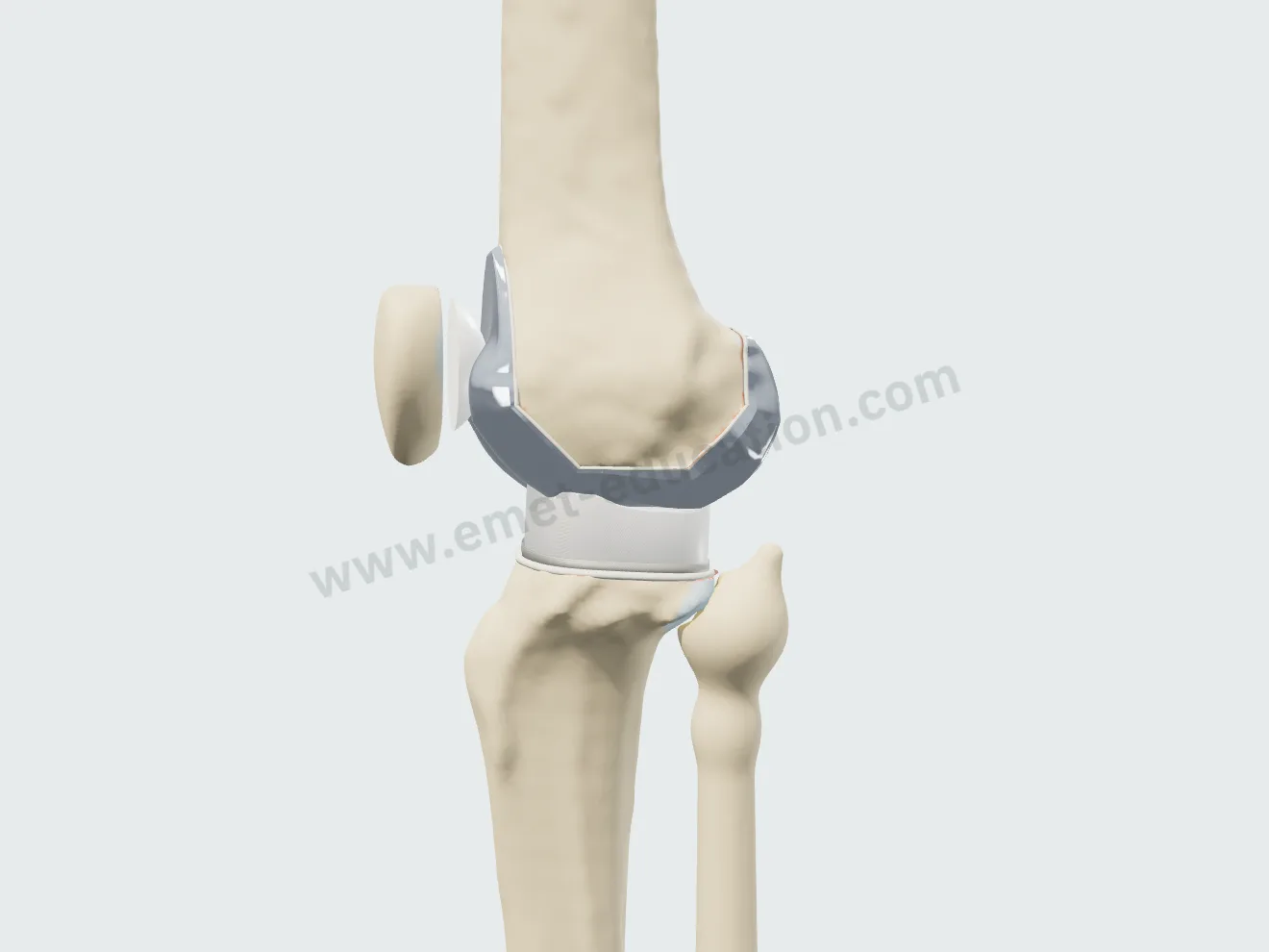 Total arthroplasty, step 5: dome-shaped patellar button.