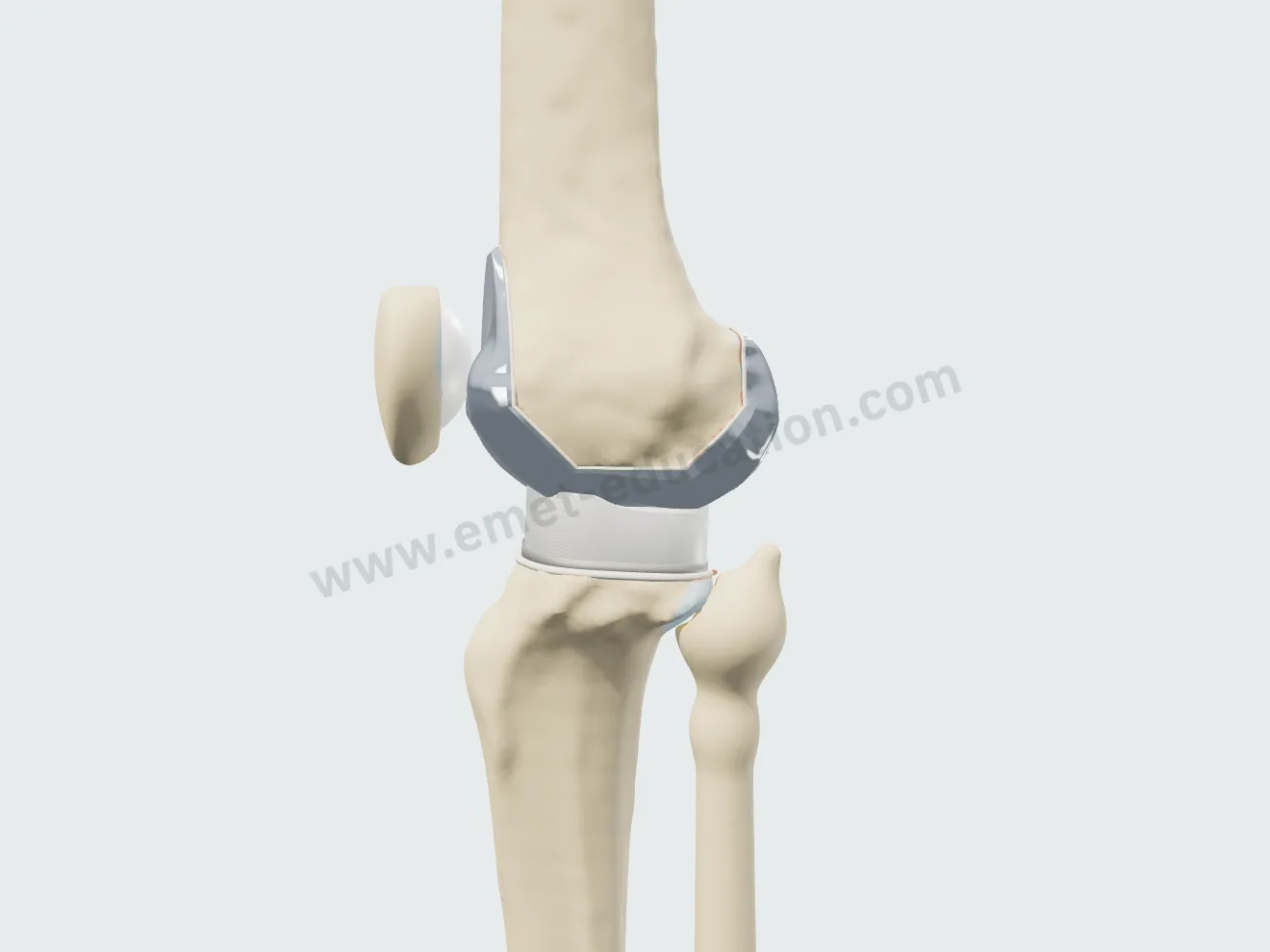 Total arthroplasty, step 6: demonstration flexion, the cam against the insert post.