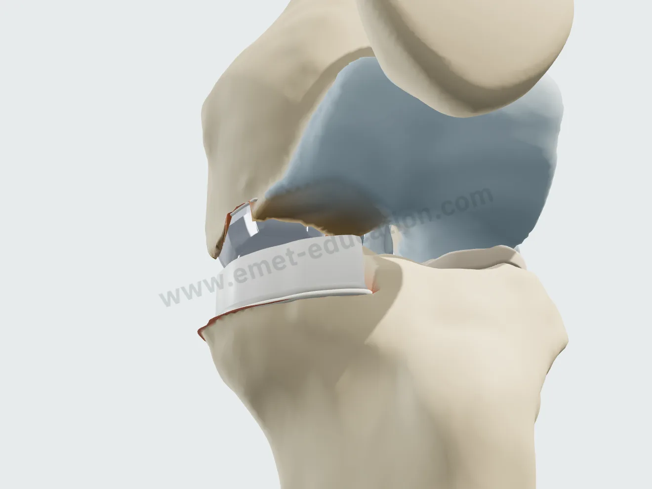 Unicompartmental arthroplasty, step 4: narrow femoral component, two pegs.