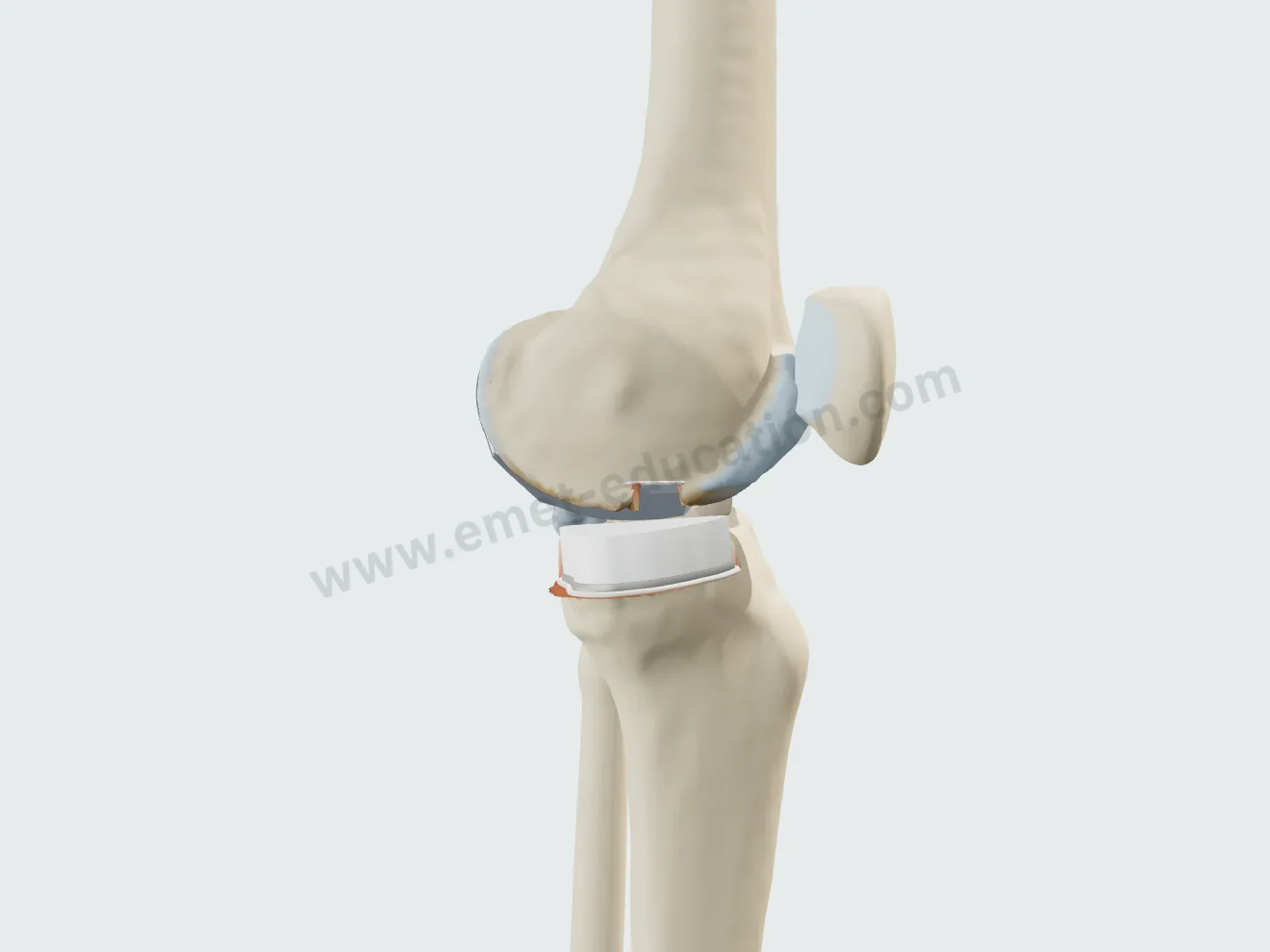 Unicompartmental arthroplasty, step 5: flexion of the operated side.