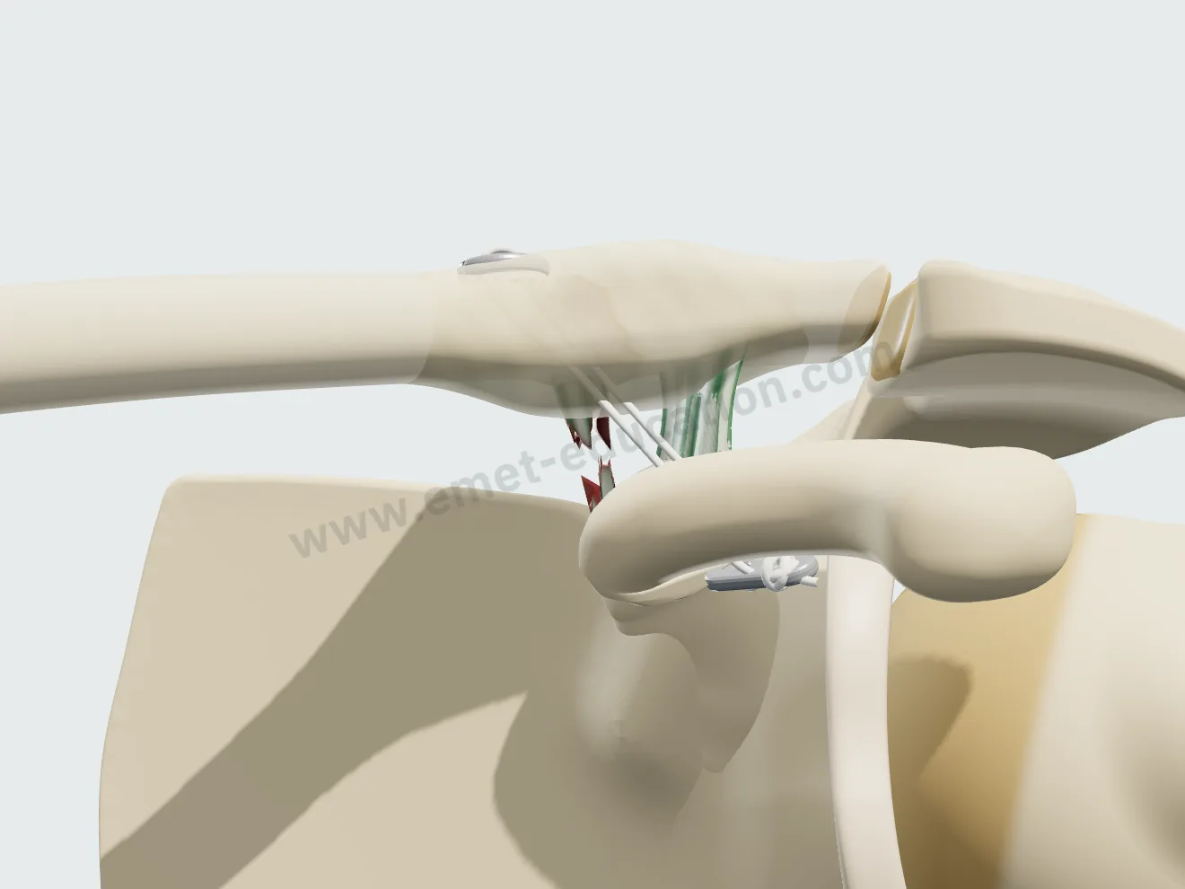 Coracoclavicular button, step 3: healing.