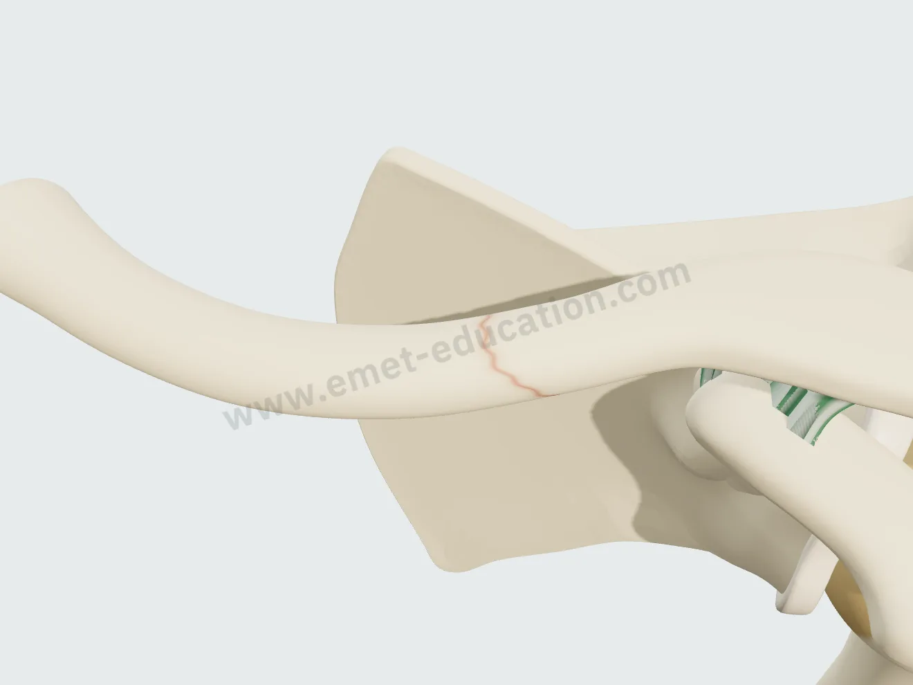 Undisplaced oblique clavicle fracture: the fracture line shown by a red outline, the clavicle keeps its shape.