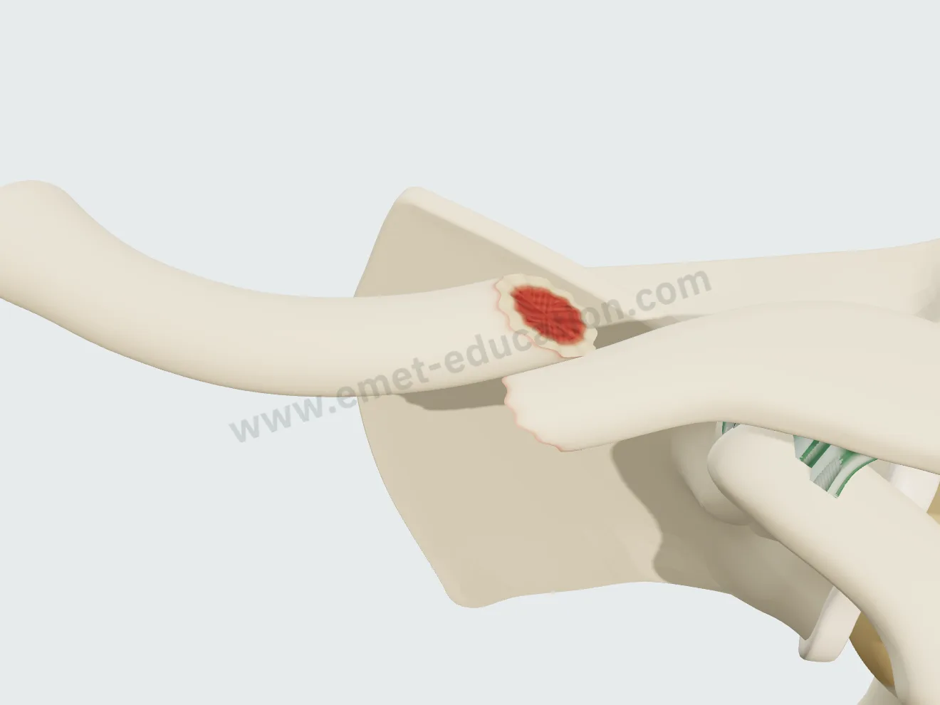 Oblique clavicle fracture, 100% displaced: the medial fragment elevated, the fragments no longer touch.