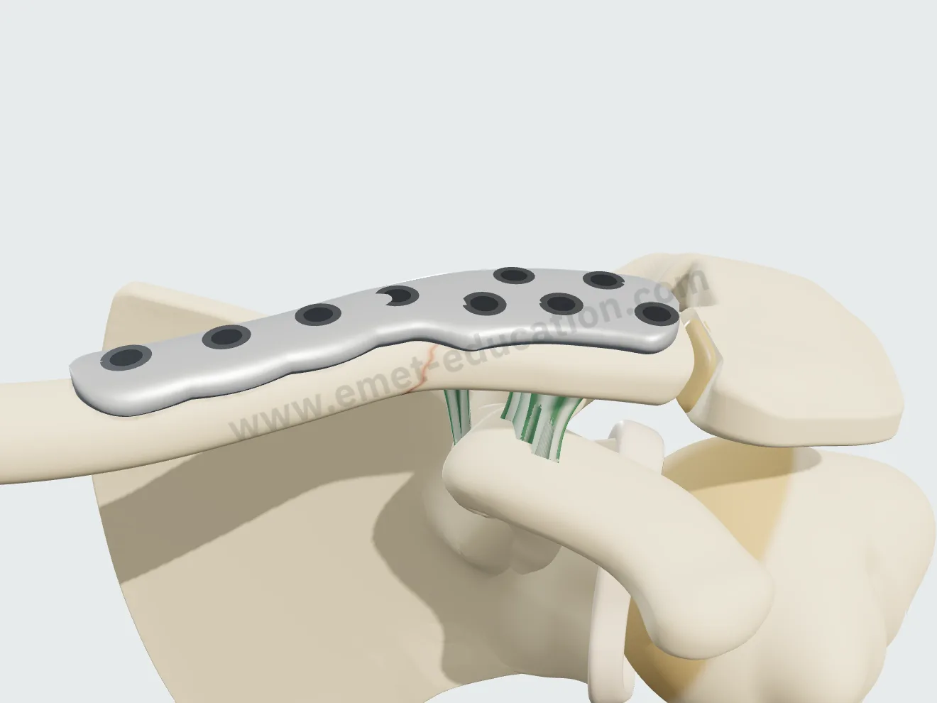 Lateral locking plate, step 2: plate.