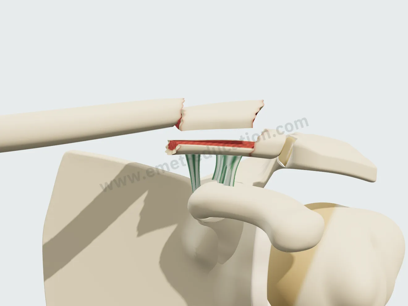 Comminuted lateral quarter fracture, Neer V: an inferior fragment keeps the ligaments, the medial fragment rises.