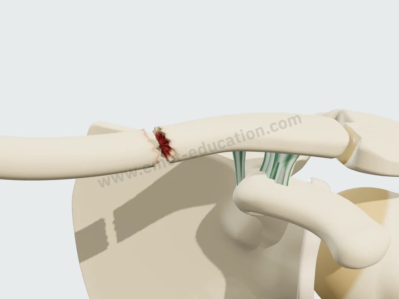 Clavicle nonunion, first stage: eroded bone ends, a gap opened between the fragments.