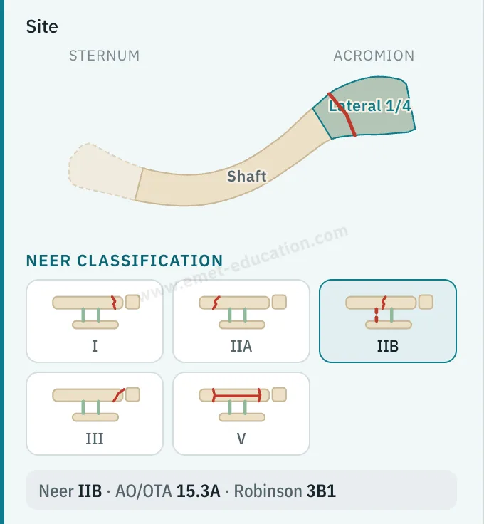 Clavicle model panel: location diagram, lateral third selected, Neer classification pictograms, IIB selected.