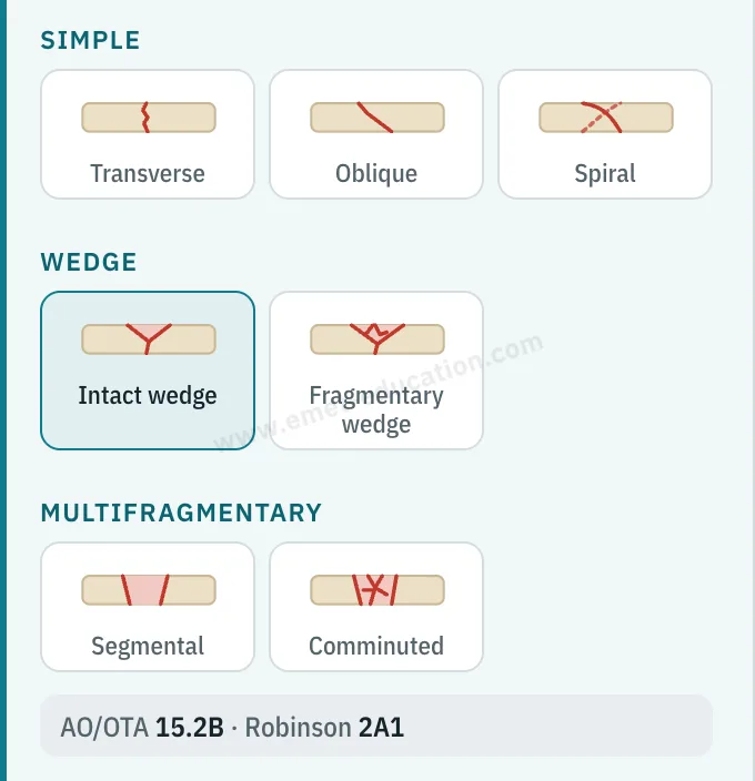 Model panel: seven fracture pattern pictograms (transverse, oblique, spiral, intact wedge, fragmentary wedge, segmental, comminuted), intact wedge selected, AO/OTA 15.2B, Robinson 2A1.