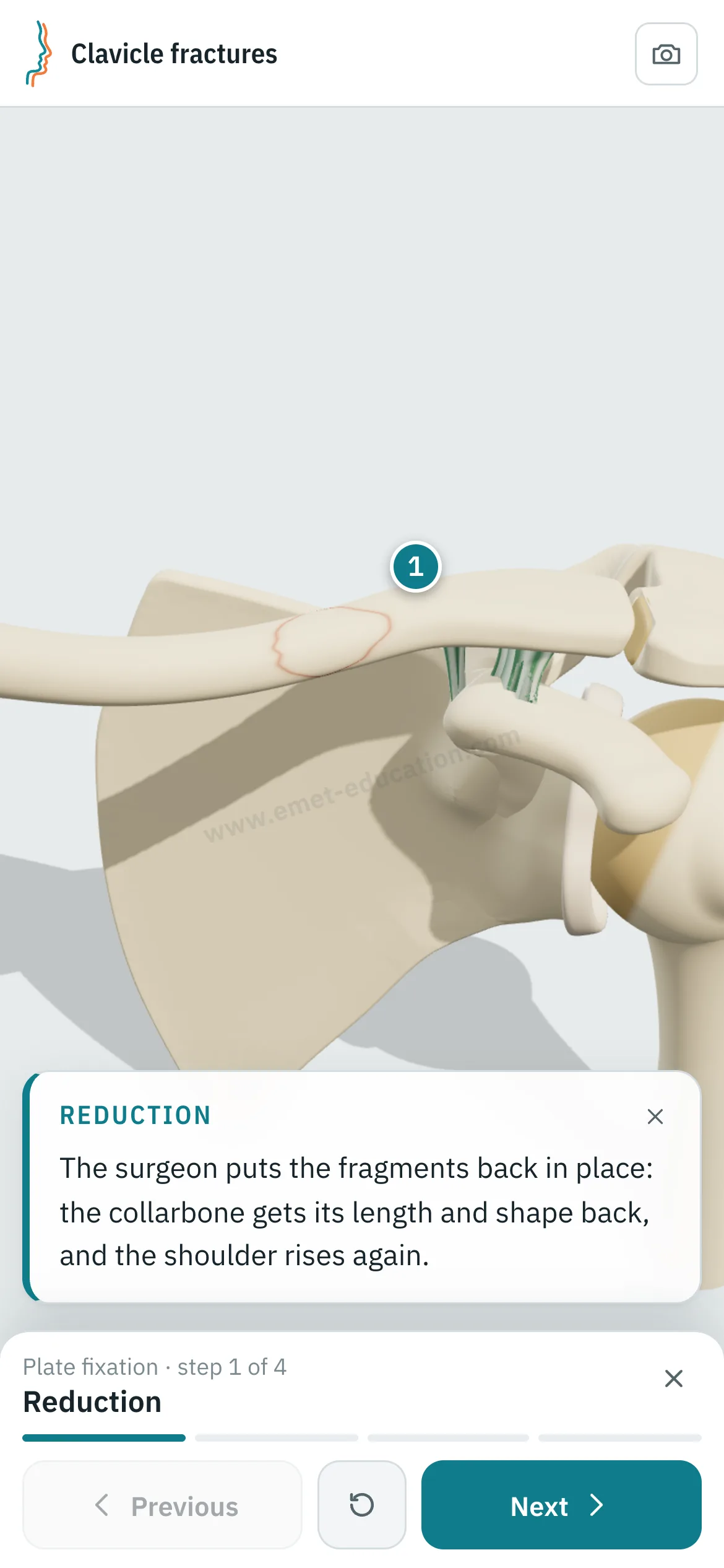 Patient view on a phone: the plate fixation replayed, step 1 of 4, reduction.