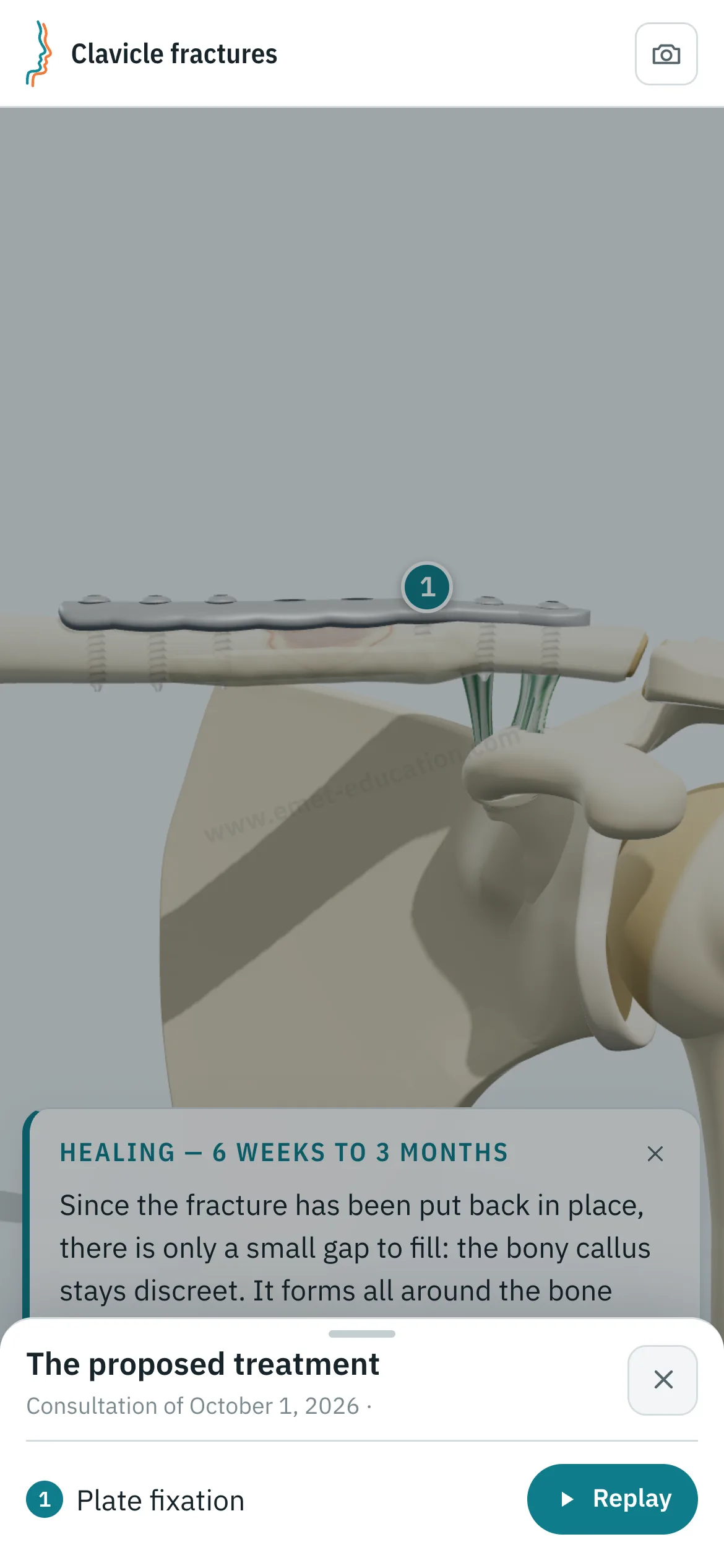 Patient view on a phone: the clavicle after plate fixation, and the “The proposed treatment” panel with the “Replay” button.