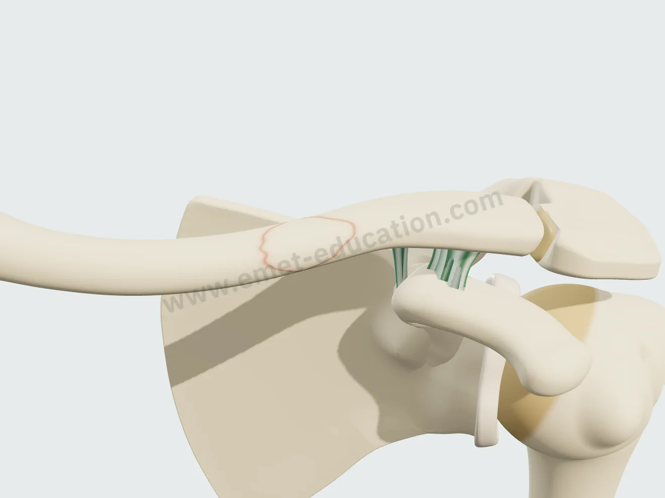 Plate fixation, step 1: reduction.