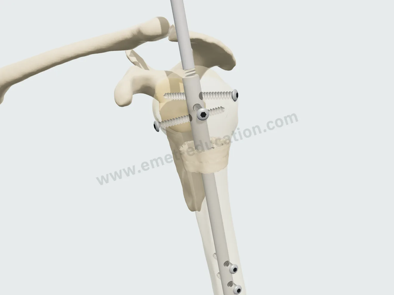 Nail removal, step 1: the end cap unscrewed, the extractor threaded into the top of the nail.