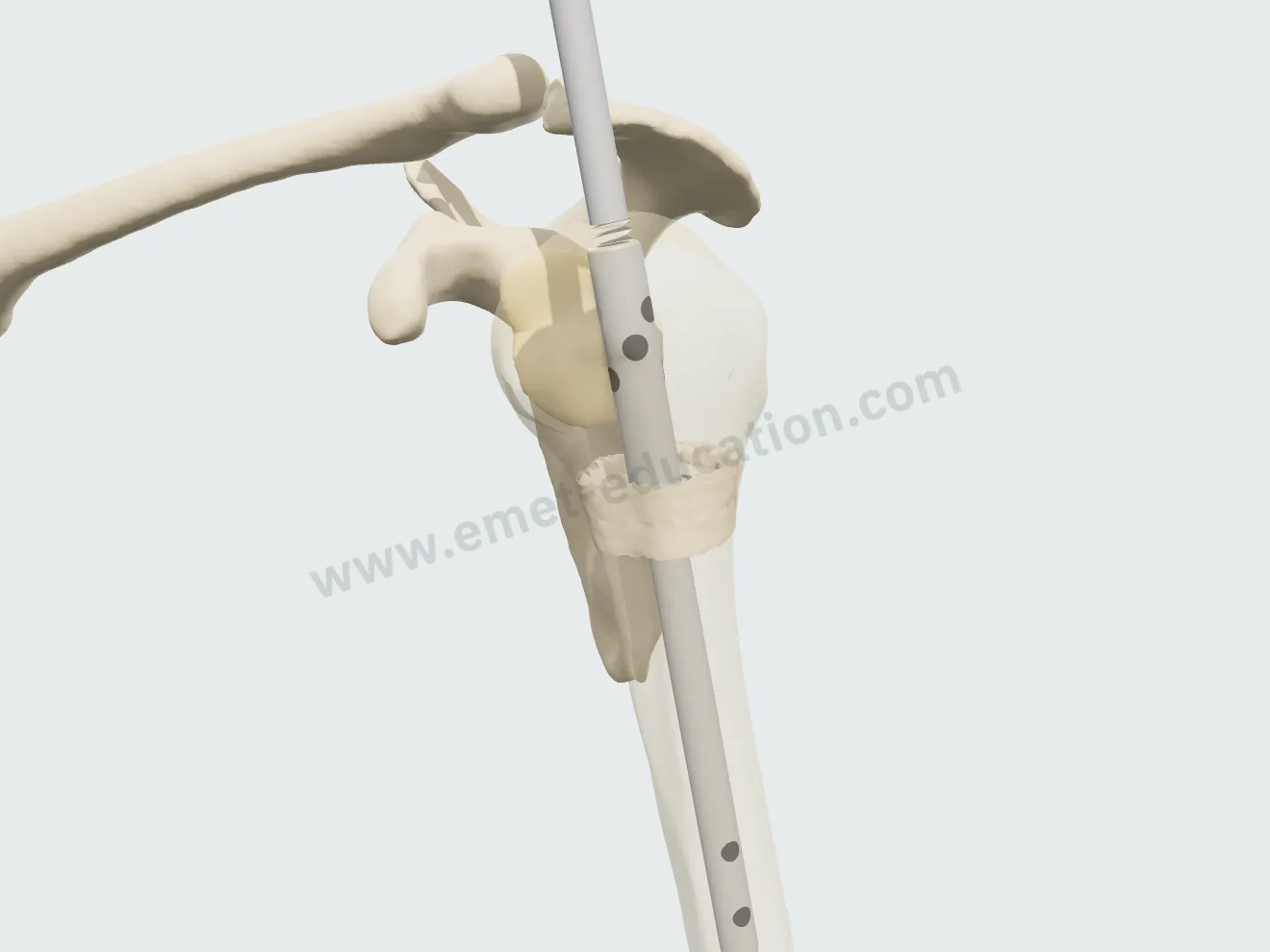 Nail removal, step 2: the screws removed, the locking holes visible.