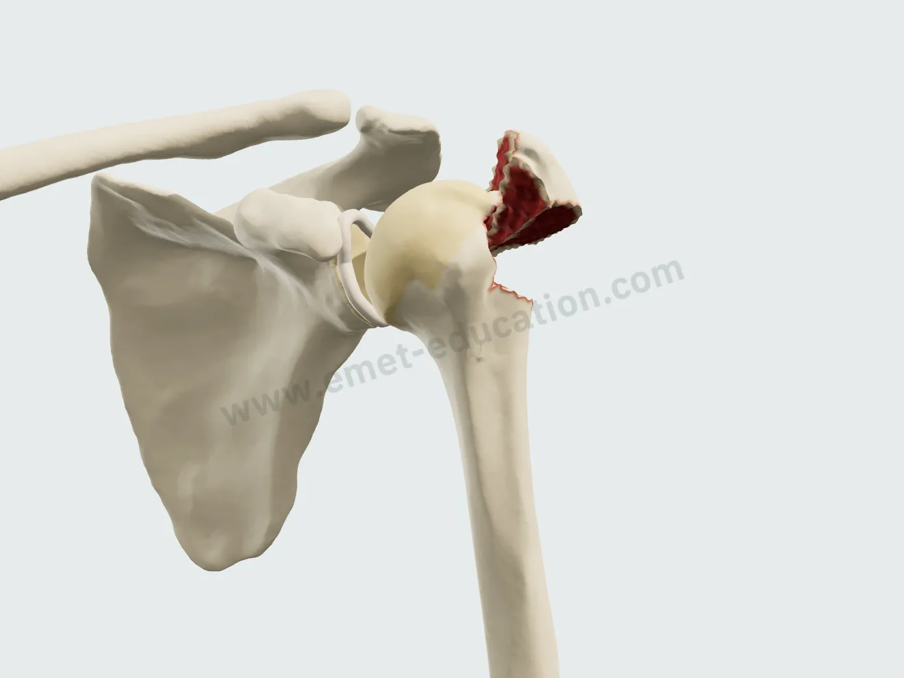 Greater tuberosity fracture displaced 15 mm, superiorly and posteriorly: Neer 2-part.