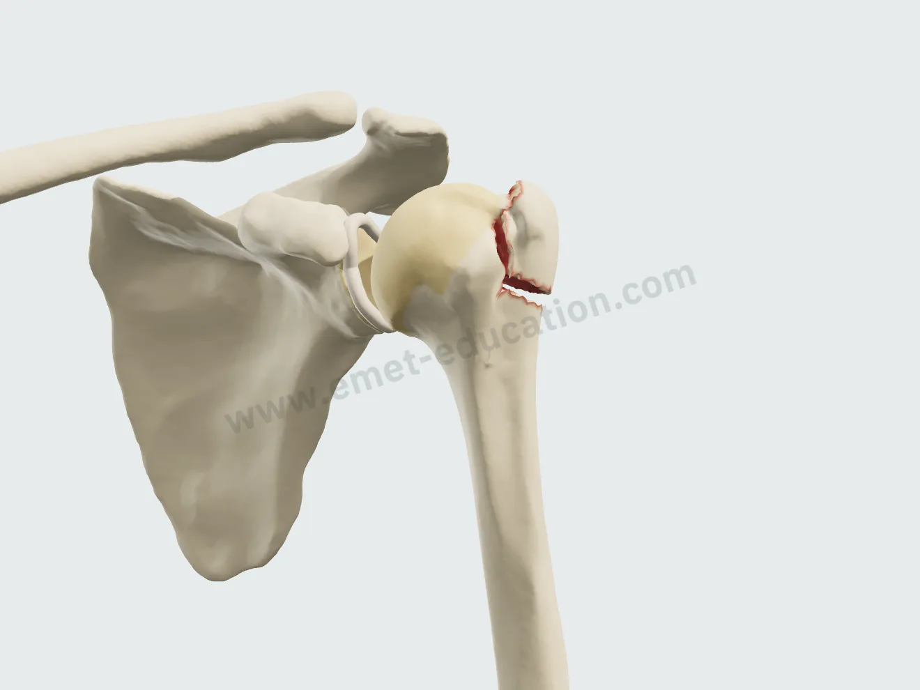Greater tuberosity fracture displaced 5 mm, without tilt: under the 1 cm threshold, Neer counts it as undisplaced.