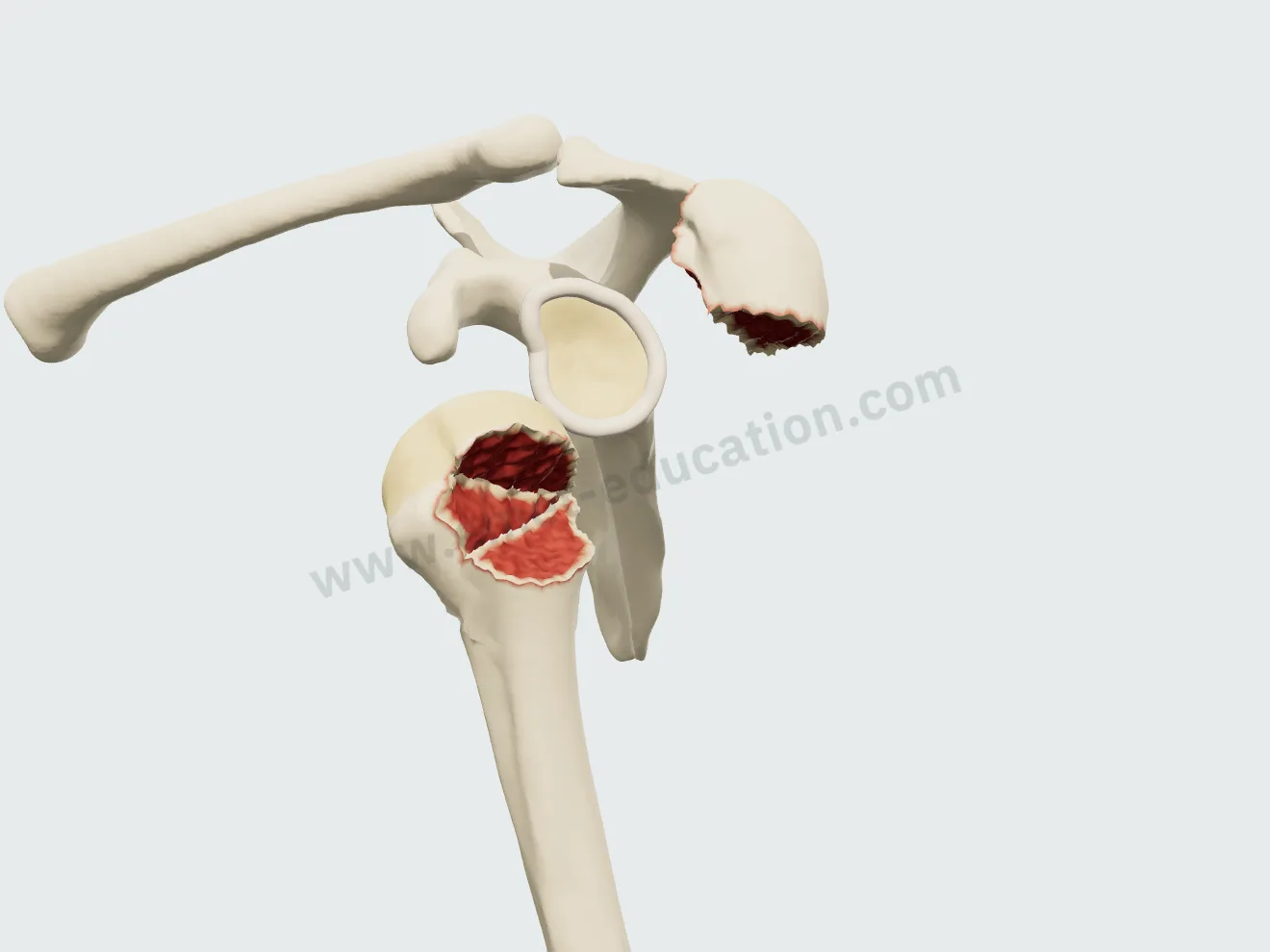 Greater tuberosity fracture with anterior dislocation: the head under the coracoid, the tuberosity left superiorly, held by the cuff.