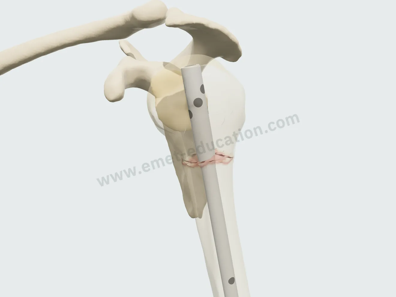 Intramedullary nail, step 3: the nail in the canal, the bone faded.