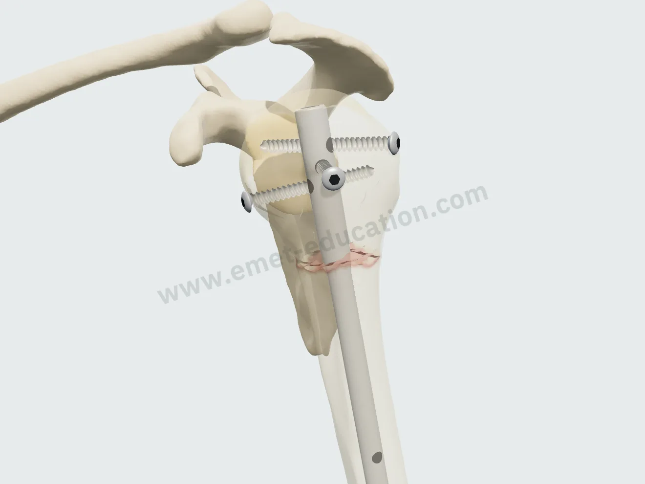 Intramedullary nail, step 4: three locked screws in the head and tuberosities.