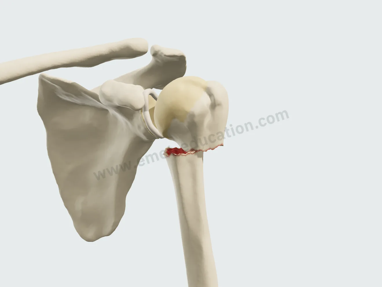 2-part surgical neck fracture of the proximal humerus: the shaft translated medially under the head.