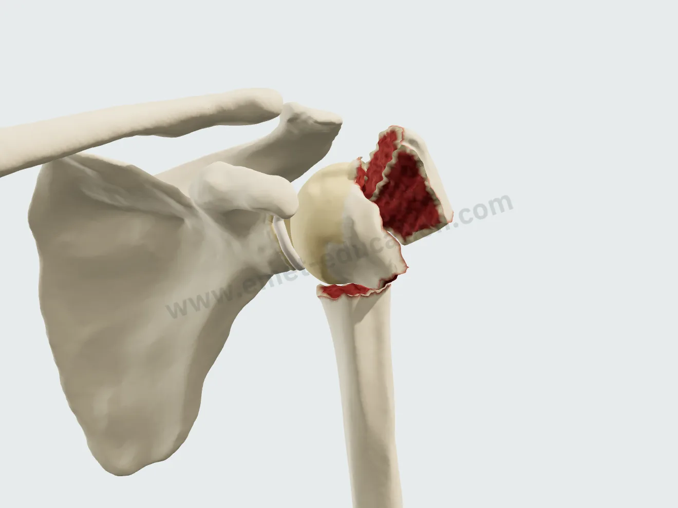 Nonoperative treatment, starting point: 3-part fracture, greater tuberosity displaced, head in varus.