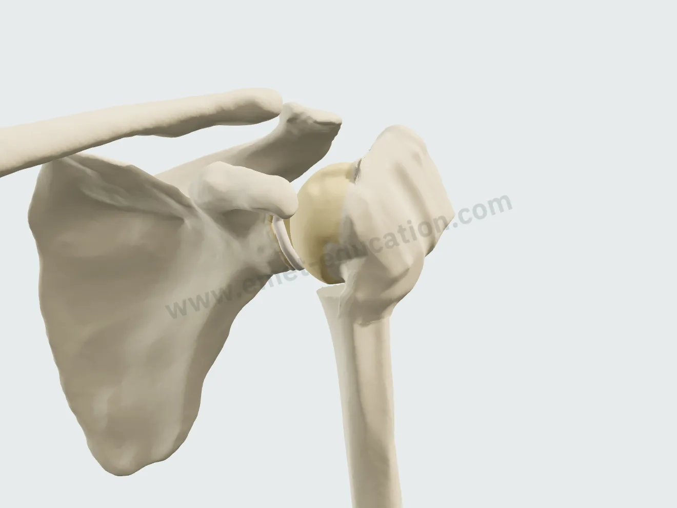 Nonoperative treatment, step 4: remodeling; the healed humerus keeps the displacement.