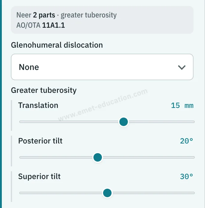 Model panel: classification read live (Neer 2-part · greater tuberosity, AO/OTA 11A1.1), greater tuberosity sliders: 15 mm translation, 20° posterior and 30° superior tilt.