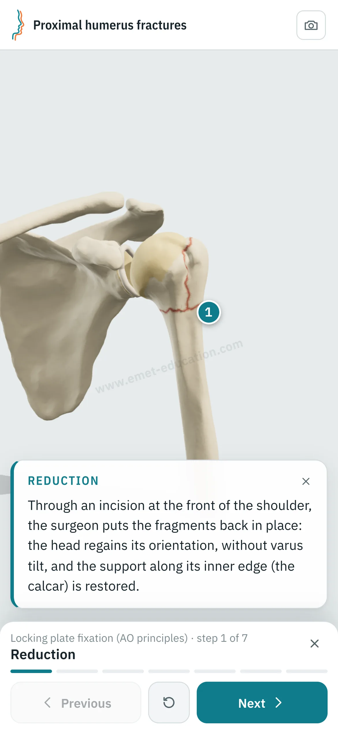 Patient view on a phone: the locking plate fixation replayed step by step.