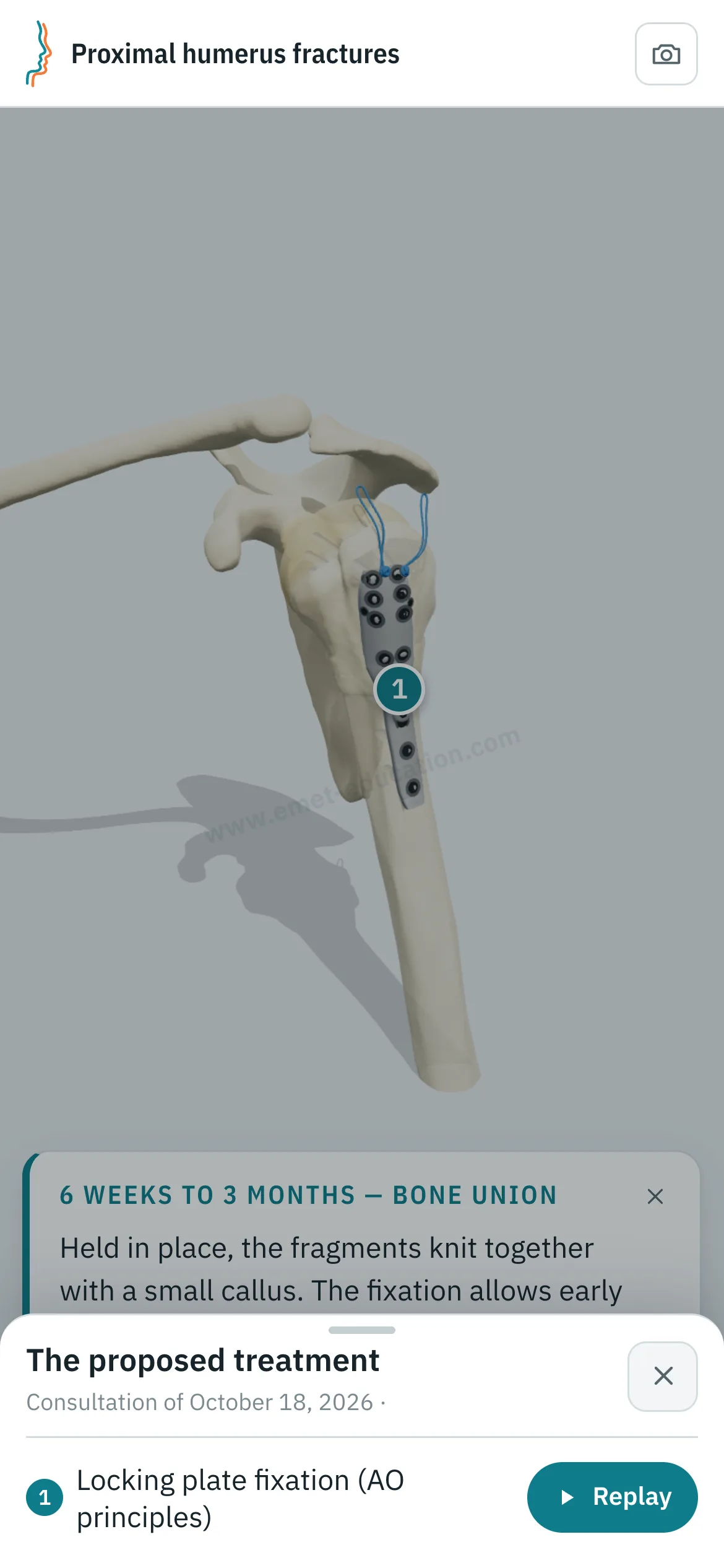 Patient view on a phone: the humerus after locking plate fixation, and the “The proposed treatment” panel open, with the “Replay” button.