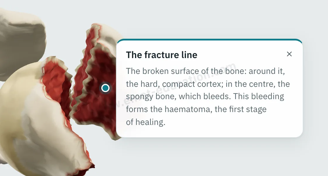 Explanation bubble “The fracture line” shown after tapping the cut surface of the greater tuberosity: the cortex, the bleeding cancellous bone, the hematoma.