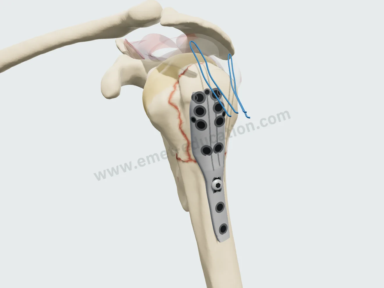 Locking plate, step 3: the plate placed posterior to the bicipital groove, below the top of the greater tuberosity.