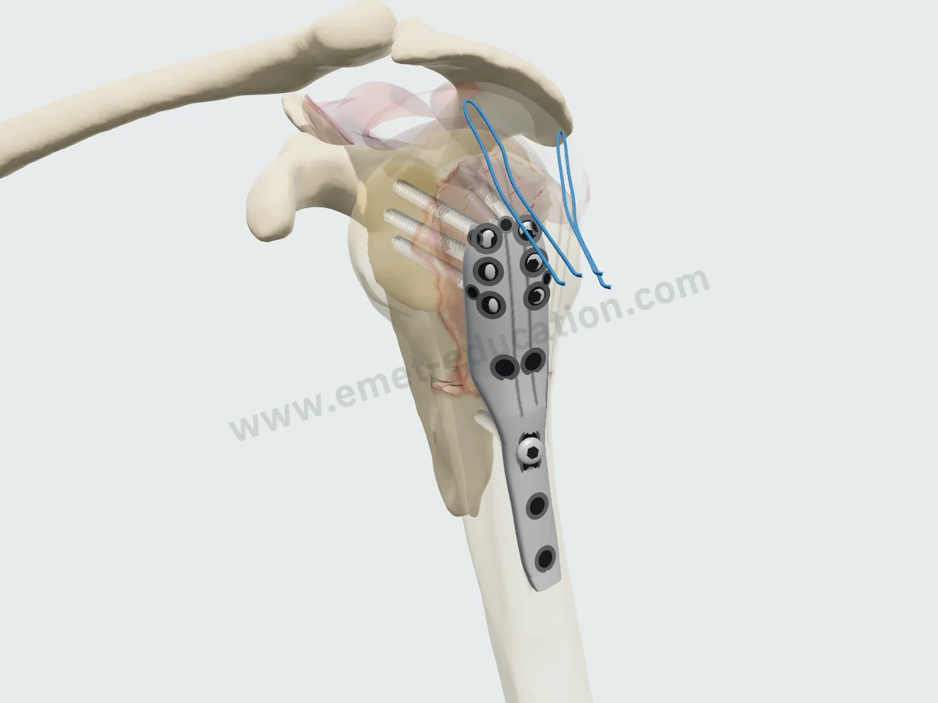 Locking plate, step 4: six divergent head screws, the bone faded.