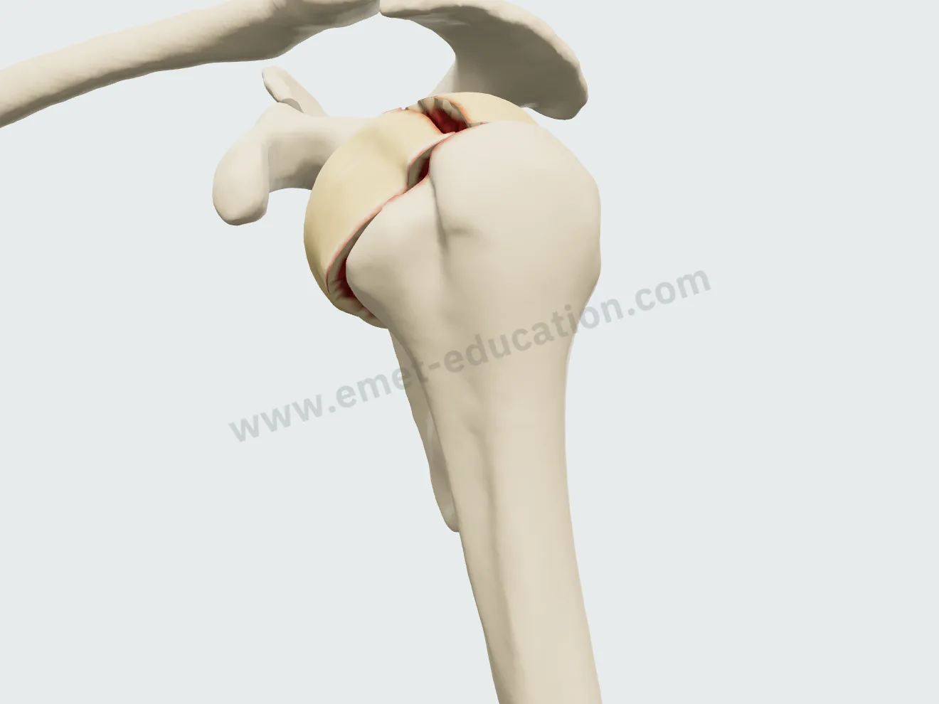 Humeral head split: the anterior fragment hinged open by 5 mm.