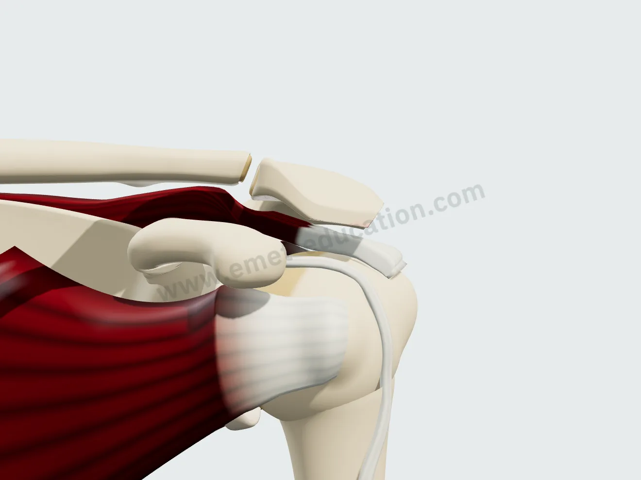 Acromioplasty, step 3: the lateral edge shaved into a bevel, front view.