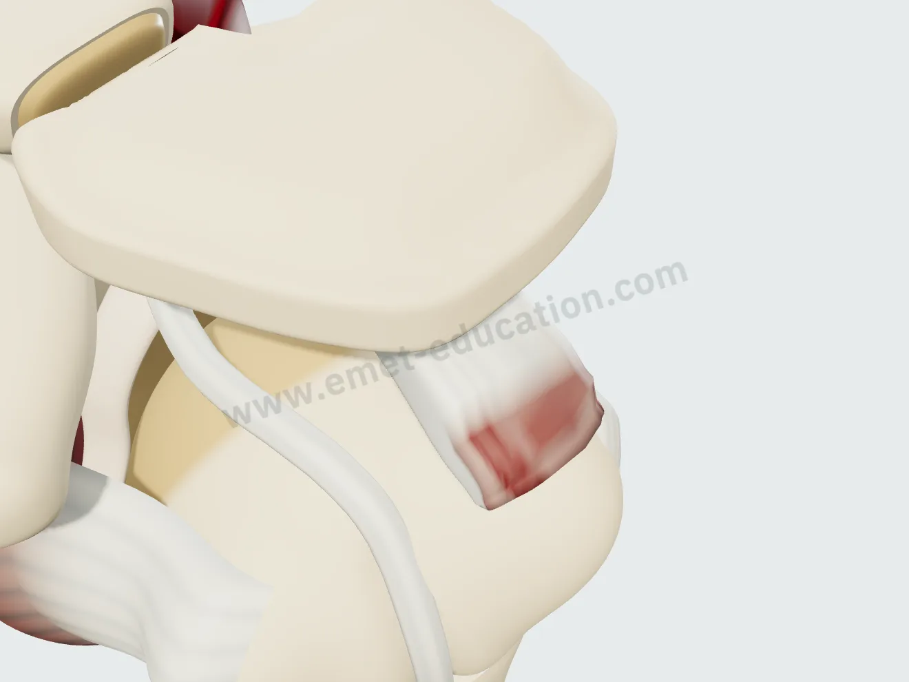 Bursal-sided partial-thickness supraspinatus tear involving 30% of the thickness.