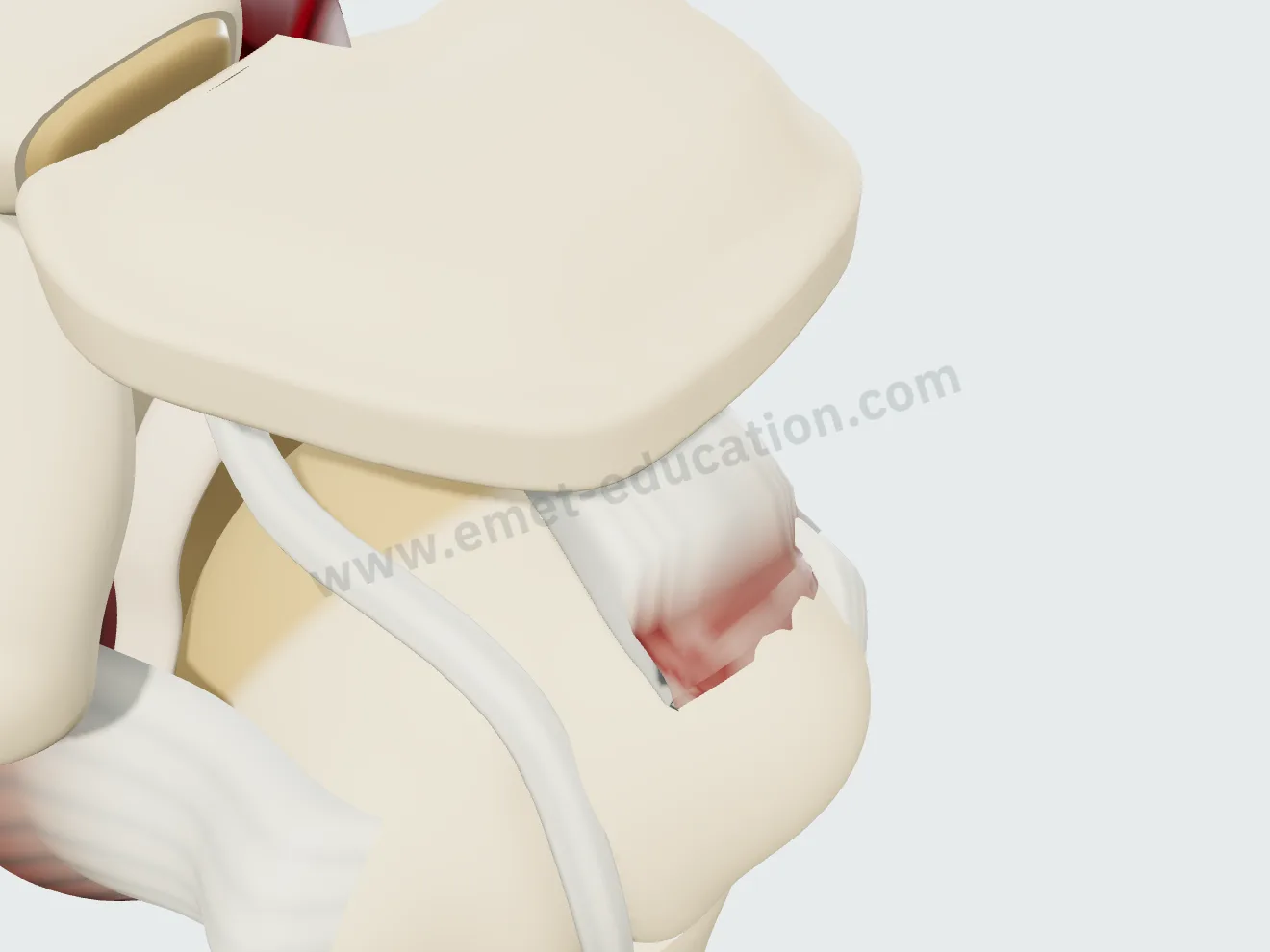 Bursal-sided partial-thickness supraspinatus tear involving 90% of the thickness: only a thin layer of tendon remains.