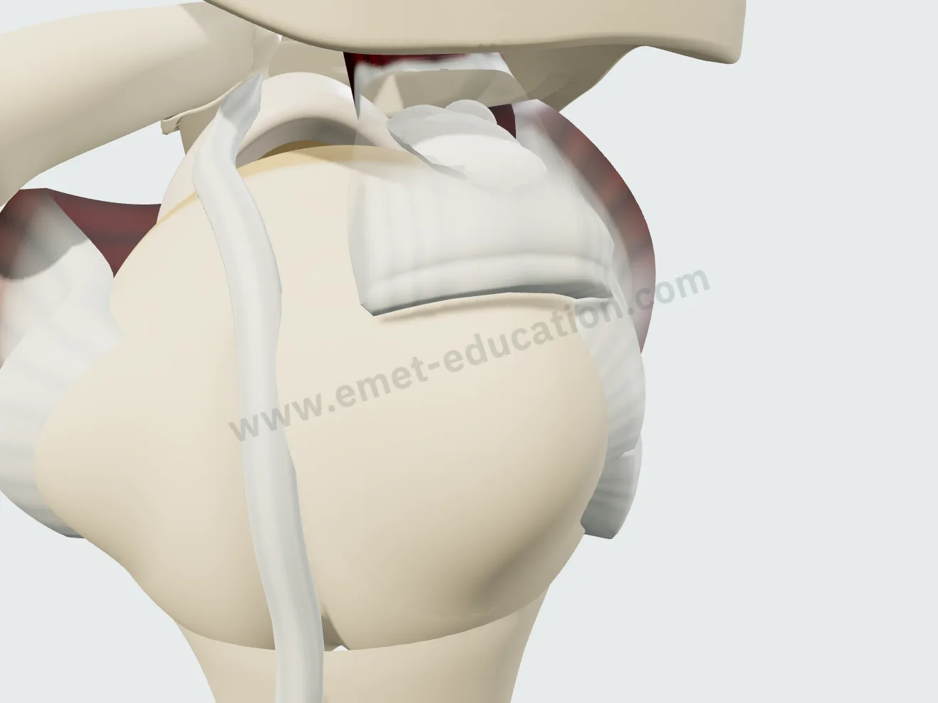 Type B supraspinatus calcification: a larger, multilobulated deposit.
