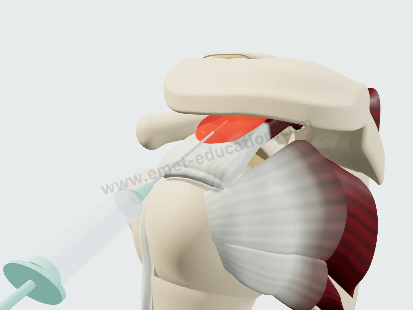 Subacromial injection, step 1: the needle in the inflamed bursa, under the edge of the acromion.