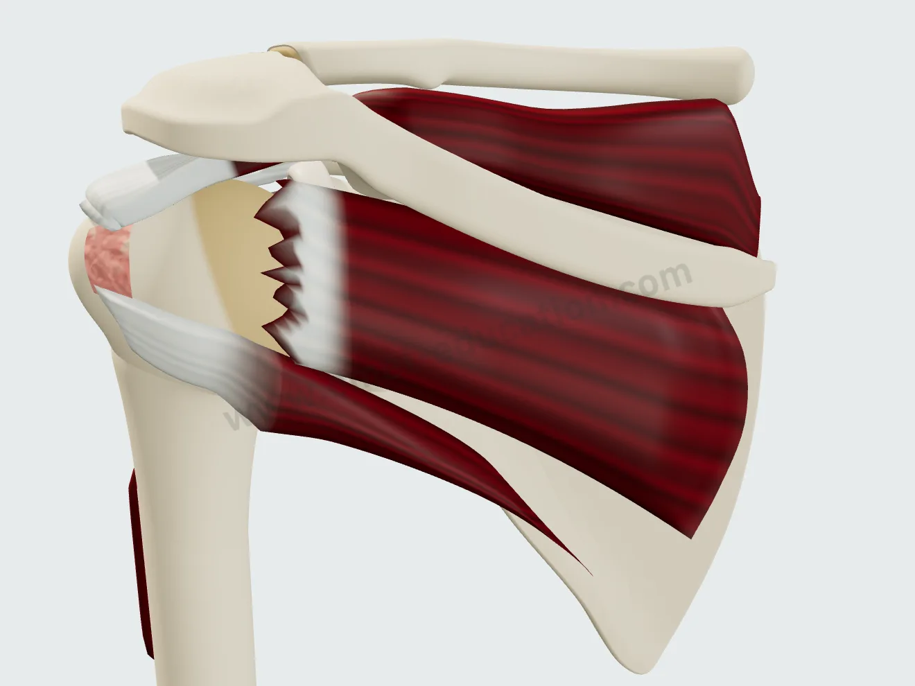 Posterior view: retracted infraspinatus tear (stage 2), the middle facet of the greater tuberosity exposed.
