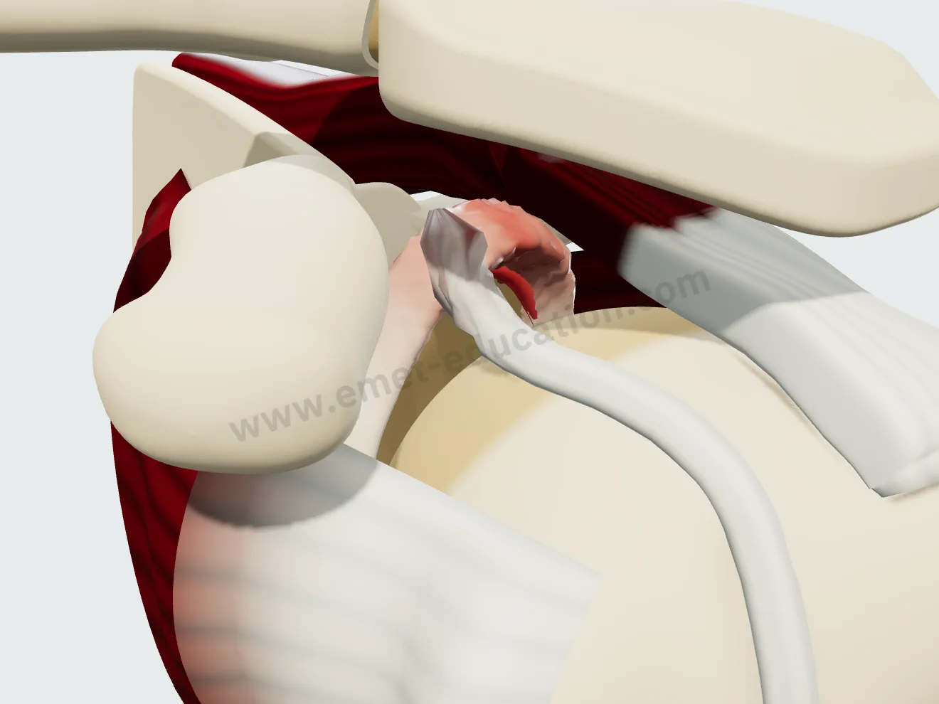 SLAP lesion: frayed biceps insertion, superior labrum detached from the glenoid.