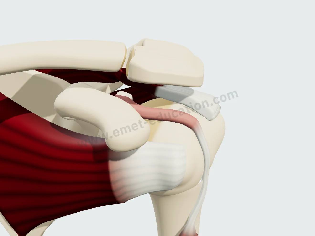 Biceps tenosynovitis: the intra-articular portion of the tendon thickened and red.