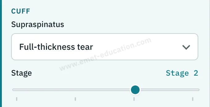 Model panel: supraspinatus, full-thickness tear, stage 2.