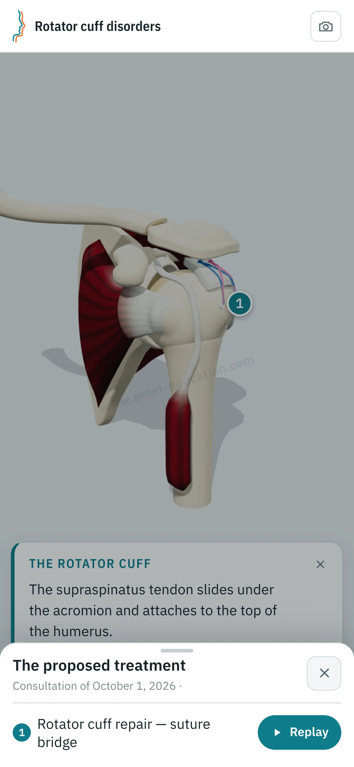 Patient view on a phone: the shoulder after suture bridge repair, and the “The proposed treatment” panel open: rotator cuff repair with suture bridge, “Replay” button.