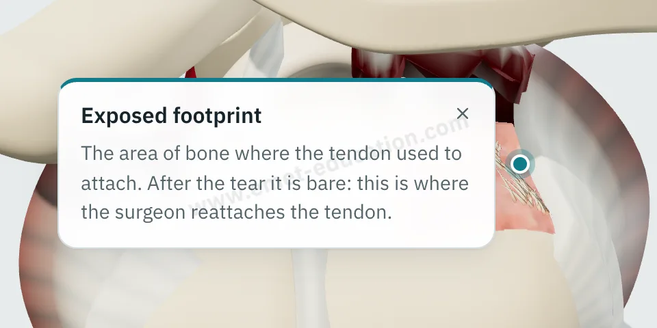 Explanation bubble “Exposed footprint” shown after tapping the greater tuberosity uncovered by the tear.