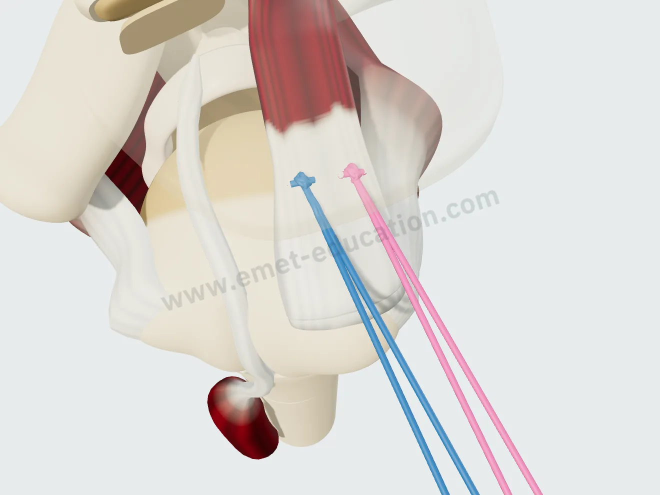 Suture bridge repair, step 3: medial row tied, the tendon reduced onto the footprint.