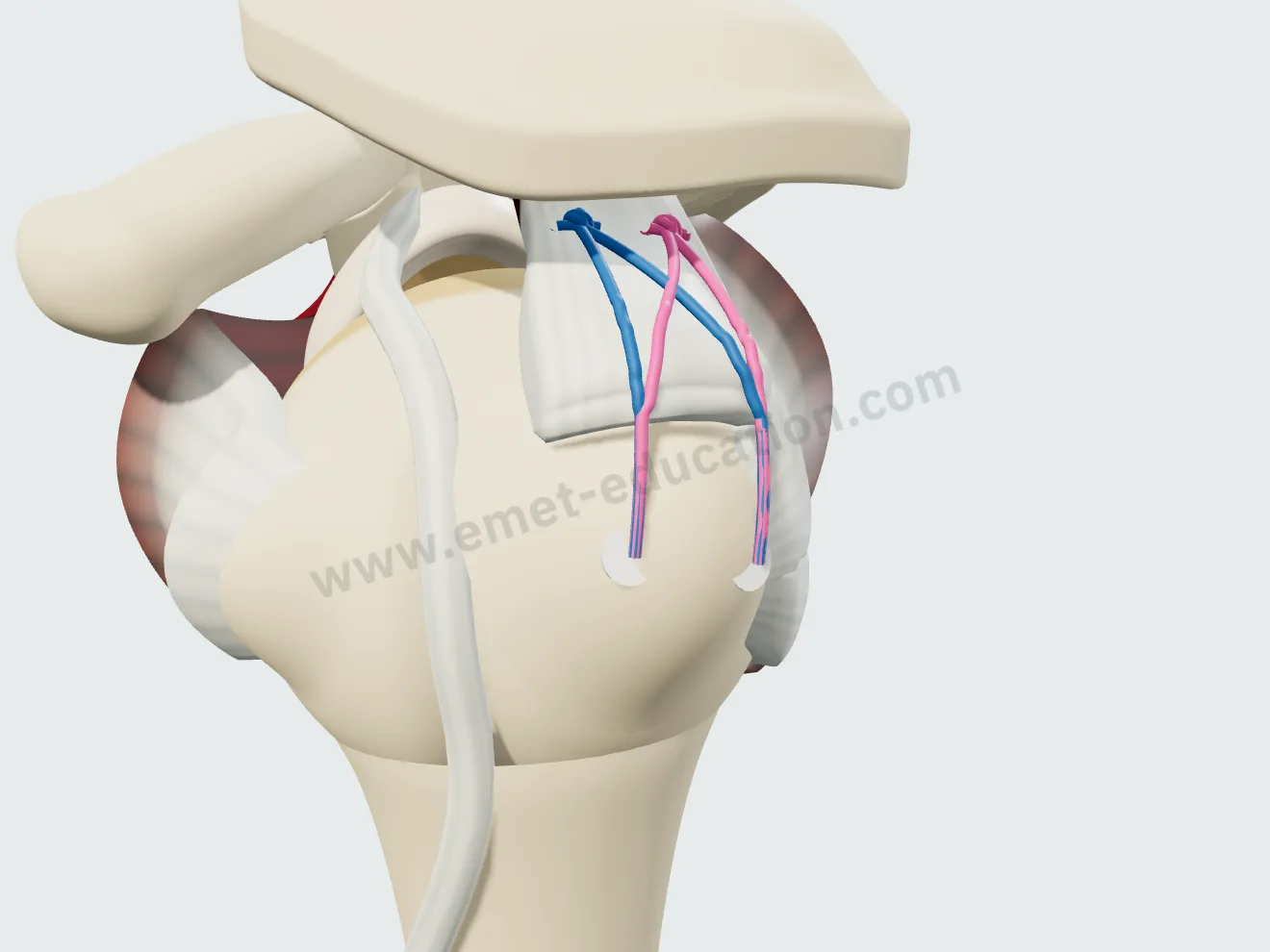 Suture bridge repair, step 4: limbs crossed in an X, secured in the lateral anchors.