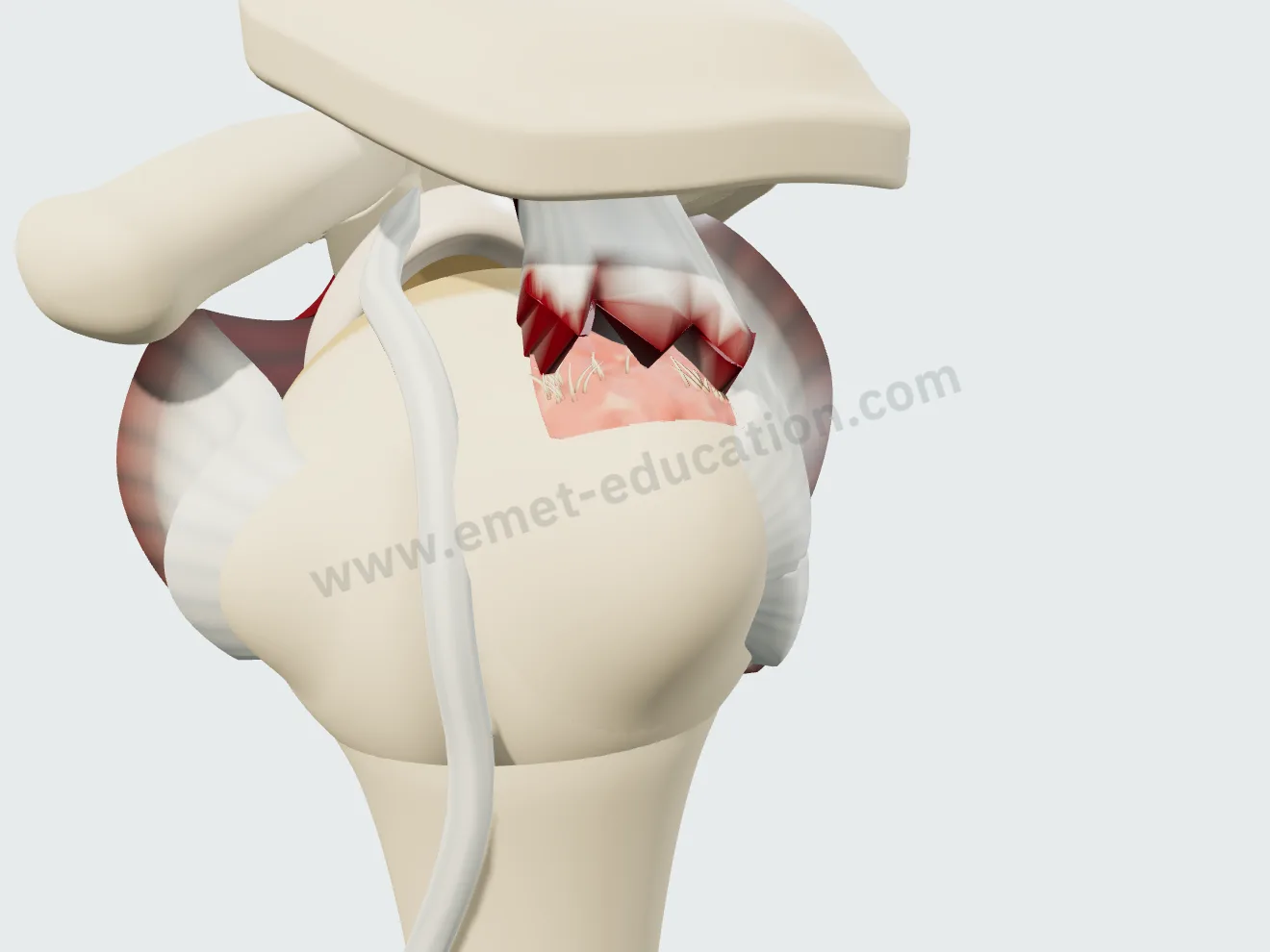 Non-retracted full-thickness supraspinatus tear (stage 1): the jagged tendon edge against the exposed footprint.
